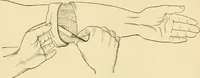 An illustration from Surgical technic; a text-book on operative surgery / by Fr. von Esmarch ... and E. Kowalzig ... translated by Professor Ludwig H. Grau ... and Willam N. Sullivan ... edited by Nicholas Senn ... With fourteen hundred and ninety-seven illustrations and fifteen colored plates. (1901)