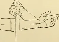 An illustration from Surgical technic; a text-book on operative surgery / by Fr. von Esmarch ... and E. Kowalzig ... translated by Professor Ludwig H. Grau ... and Willam N. Sullivan ... edited by Nicholas Senn ... With fourteen hundred and ninety-seven illustrations and fifteen colored plates. (1901)