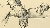 An illustration from Surgical technic; a text-book on operative surgery / by Fr. von Esmarch ... and E. Kowalzig ... translated by Professor Ludwig H. Grau ... and Willam N. Sullivan ... edited by Nicholas Senn ... With fourteen hundred and ninety-seven illustrations and fifteen colored plates. (1901)
