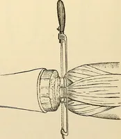 An illustration from Surgical technic; a text-book on operative surgery / by Fr. von Esmarch ... and E. Kowalzig ... translated by Professor Ludwig H. Grau ... and Willam N. Sullivan ... edited by Nicholas Senn ... With fourteen hundred and ninety-seven illustrations and fifteen colored plates. (1901)