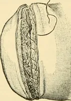 An illustration from Surgical technic; a text-book on operative surgery / by Fr. von Esmarch ... and E. Kowalzig ... translated by Professor Ludwig H. Grau ... and Willam N. Sullivan ... edited by Nicholas Senn ... With fourteen hundred and ninety-seven illustrations and fifteen colored plates. (1901)