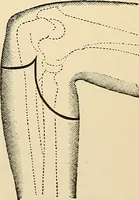 An illustration from Surgical technic; a text-book on operative surgery / by Fr. von Esmarch ... and E. Kowalzig ... translated by Professor Ludwig H. Grau ... and Willam N. Sullivan ... edited by Nicholas Senn ... With fourteen hundred and ninety-seven illustrations and fifteen colored plates. (1901)