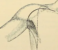 An illustration from Surgical technic; a text-book on operative surgery / by Fr. von Esmarch ... and E. Kowalzig ... translated by Professor Ludwig H. Grau ... and Willam N. Sullivan ... edited by Nicholas Senn ... With fourteen hundred and ninety-seven illustrations and fifteen colored plates. (1901)
