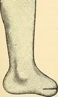 An illustration from Surgical technic; a text-book on operative surgery / by Fr. von Esmarch ... and E. Kowalzig ... translated by Professor Ludwig H. Grau ... and Willam N. Sullivan ... edited by Nicholas Senn ... With fourteen hundred and ninety-seven illustrations and fifteen colored plates. (1901)
