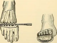 An illustration from Surgical technic; a text-book on operative surgery / by Fr. von Esmarch ... and E. Kowalzig ... translated by Professor Ludwig H. Grau ... and Willam N. Sullivan ... edited by Nicholas Senn ... With fourteen hundred and ninety-seven illustrations and fifteen colored plates. (1901)
