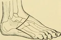An illustration from Surgical technic; a text-book on operative surgery / by Fr. von Esmarch ... and E. Kowalzig ... translated by Professor Ludwig H. Grau ... and Willam N. Sullivan ... edited by Nicholas Senn ... With fourteen hundred and ninety-seven illustrations and fifteen colored plates. (1901)