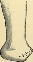 An illustration from Surgical technic; a text-book on operative surgery / by Fr. von Esmarch ... and E. Kowalzig ... translated by Professor Ludwig H. Grau ... and Willam N. Sullivan ... edited by Nicholas Senn ... With fourteen hundred and ninety-seven illustrations and fifteen colored plates. (1901)