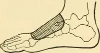 An illustration from Surgical technic; a text-book on operative surgery / by Fr. von Esmarch ... and E. Kowalzig ... translated by Professor Ludwig H. Grau ... and Willam N. Sullivan ... edited by Nicholas Senn ... With fourteen hundred and ninety-seven illustrations and fifteen colored plates. (1901)