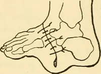 An illustration from Surgical technic; a text-book on operative surgery / by Fr. von Esmarch ... and E. Kowalzig ... translated by Professor Ludwig H. Grau ... and Willam N. Sullivan ... edited by Nicholas Senn ... With fourteen hundred and ninety-seven illustrations and fifteen colored plates. (1901)