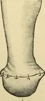 An illustration from Surgical technic; a text-book on operative surgery / by Fr. von Esmarch ... and E. Kowalzig ... translated by Professor Ludwig H. Grau ... and Willam N. Sullivan ... edited by Nicholas Senn ... With fourteen hundred and ninety-seven illustrations and fifteen colored plates. (1901)