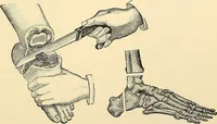 An illustration from Surgical technic; a text-book on operative surgery / by Fr. von Esmarch ... and E. Kowalzig ... translated by Professor Ludwig H. Grau ... and Willam N. Sullivan ... edited by Nicholas Senn ... With fourteen hundred and ninety-seven illustrations and fifteen colored plates. (1901)