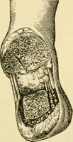 An illustration from Surgical technic; a text-book on operative surgery / by Fr. von Esmarch ... and E. Kowalzig ... translated by Professor Ludwig H. Grau ... and Willam N. Sullivan ... edited by Nicholas Senn ... With fourteen hundred and ninety-seven illustrations and fifteen colored plates. (1901)