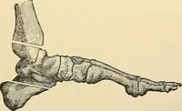 An illustration from Surgical technic; a text-book on operative surgery / by Fr. von Esmarch ... and E. Kowalzig ... translated by Professor Ludwig H. Grau ... and Willam N. Sullivan ... edited by Nicholas Senn ... With fourteen hundred and ninety-seven illustrations and fifteen colored plates. (1901)