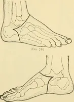An illustration from Surgical technic; a text-book on operative surgery / by Fr. von Esmarch ... and E. Kowalzig ... translated by Professor Ludwig H. Grau ... and Willam N. Sullivan ... edited by Nicholas Senn ... With fourteen hundred and ninety-seven illustrations and fifteen colored plates. (1901)