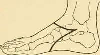 An illustration from Surgical technic; a text-book on operative surgery / by Fr. von Esmarch ... and E. Kowalzig ... translated by Professor Ludwig H. Grau ... and Willam N. Sullivan ... edited by Nicholas Senn ... With fourteen hundred and ninety-seven illustrations and fifteen colored plates. (1901)