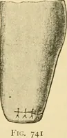 An illustration from Surgical technic; a text-book on operative surgery / by Fr. von Esmarch ... and E. Kowalzig ... translated by Professor Ludwig H. Grau ... and Willam N. Sullivan ... edited by Nicholas Senn ... With fourteen hundred and ninety-seven illustrations and fifteen colored plates. (1901)