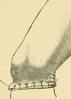 An illustration from Surgical technic; a text-book on operative surgery / by Fr. von Esmarch ... and E. Kowalzig ... translated by Professor Ludwig H. Grau ... and Willam N. Sullivan ... edited by Nicholas Senn ... With fourteen hundred and ninety-seven illustrations and fifteen colored plates. (1901)
