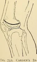 An illustration from Surgical technic; a text-book on operative surgery / by Fr. von Esmarch ... and E. Kowalzig ... translated by Professor Ludwig H. Grau ... and Willam N. Sullivan ... edited by Nicholas Senn ... With fourteen hundred and ninety-seven illustrations and fifteen colored plates. (1901)