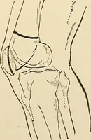 An illustration from Surgical technic; a text-book on operative surgery / by Fr. von Esmarch ... and E. Kowalzig ... translated by Professor Ludwig H. Grau ... and Willam N. Sullivan ... edited by Nicholas Senn ... With fourteen hundred and ninety-seven illustrations and fifteen colored plates. (1901)