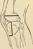 An illustration from Surgical technic; a text-book on operative surgery / by Fr. von Esmarch ... and E. Kowalzig ... translated by Professor Ludwig H. Grau ... and Willam N. Sullivan ... edited by Nicholas Senn ... With fourteen hundred and ninety-seven illustrations and fifteen colored plates. (1901)
