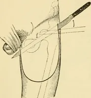An illustration from Surgical technic; a text-book on operative surgery / by Fr. von Esmarch ... and E. Kowalzig ... translated by Professor Ludwig H. Grau ... and Willam N. Sullivan ... edited by Nicholas Senn ... With fourteen hundred and ninety-seven illustrations and fifteen colored plates. (1901)