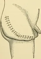 An illustration from Surgical technic; a text-book on operative surgery / by Fr. von Esmarch ... and E. Kowalzig ... translated by Professor Ludwig H. Grau ... and Willam N. Sullivan ... edited by Nicholas Senn ... With fourteen hundred and ninety-seven illustrations and fifteen colored plates. (1901)