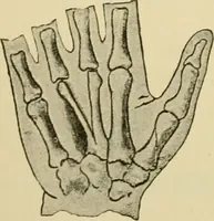 An illustration from Surgical technic; a text-book on operative surgery / by Fr. von Esmarch ... and E. Kowalzig ... translated by Professor Ludwig H. Grau ... and Willam N. Sullivan ... edited by Nicholas Senn ... With fourteen hundred and ninety-seven illustrations and fifteen colored plates. (1901)