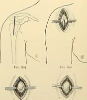 An illustration from Surgical technic; a text-book on operative surgery / by Fr. von Esmarch ... and E. Kowalzig ... translated by Professor Ludwig H. Grau ... and Willam N. Sullivan ... edited by Nicholas Senn ... With fourteen hundred and ninety-seven illustrations and fifteen colored plates. (1901)