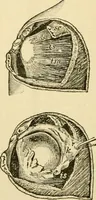 An illustration from Surgical technic; a text-book on operative surgery / by Fr. von Esmarch ... and E. Kowalzig ... translated by Professor Ludwig H. Grau ... and Willam N. Sullivan ... edited by Nicholas Senn ... With fourteen hundred and ninety-seven illustrations and fifteen colored plates. (1901)