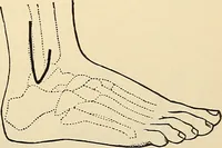 An illustration from Surgical technic; a text-book on operative surgery / by Fr. von Esmarch ... and E. Kowalzig ... translated by Professor Ludwig H. Grau ... and Willam N. Sullivan ... edited by Nicholas Senn ... With fourteen hundred and ninety-seven illustrations and fifteen colored plates. (1901)