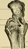 An illustration from Surgical technic; a text-book on operative surgery / by Fr. von Esmarch ... and E. Kowalzig ... translated by Professor Ludwig H. Grau ... and Willam N. Sullivan ... edited by Nicholas Senn ... With fourteen hundred and ninety-seven illustrations and fifteen colored plates. (1901)