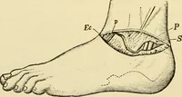 An illustration from Surgical technic; a text-book on operative surgery / by Fr. von Esmarch ... and E. Kowalzig ... translated by Professor Ludwig H. Grau ... and Willam N. Sullivan ... edited by Nicholas Senn ... With fourteen hundred and ninety-seven illustrations and fifteen colored plates. (1901)