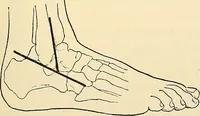 An illustration from Surgical technic; a text-book on operative surgery / by Fr. von Esmarch ... and E. Kowalzig ... translated by Professor Ludwig H. Grau ... and Willam N. Sullivan ... edited by Nicholas Senn ... With fourteen hundred and ninety-seven illustrations and fifteen colored plates. (1901)