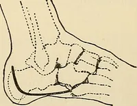 An illustration from Surgical technic; a text-book on operative surgery / by Fr. von Esmarch ... and E. Kowalzig ... translated by Professor Ludwig H. Grau ... and Willam N. Sullivan ... edited by Nicholas Senn ... With fourteen hundred and ninety-seven illustrations and fifteen colored plates. (1901)