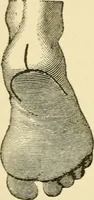 An illustration from Surgical technic; a text-book on operative surgery / by Fr. von Esmarch ... and E. Kowalzig ... translated by Professor Ludwig H. Grau ... and Willam N. Sullivan ... edited by Nicholas Senn ... With fourteen hundred and ninety-seven illustrations and fifteen colored plates. (1901)