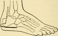 An illustration from Surgical technic; a text-book on operative surgery / by Fr. von Esmarch ... and E. Kowalzig ... translated by Professor Ludwig H. Grau ... and Willam N. Sullivan ... edited by Nicholas Senn ... With fourteen hundred and ninety-seven illustrations and fifteen colored plates. (1901)