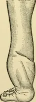 An illustration from Surgical technic; a text-book on operative surgery / by Fr. von Esmarch ... and E. Kowalzig ... translated by Professor Ludwig H. Grau ... and Willam N. Sullivan ... edited by Nicholas Senn ... With fourteen hundred and ninety-seven illustrations and fifteen colored plates. (1901)
