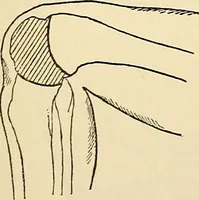 An illustration from Surgical technic; a text-book on operative surgery / by Fr. von Esmarch ... and E. Kowalzig ... translated by Professor Ludwig H. Grau ... and Willam N. Sullivan ... edited by Nicholas Senn ... With fourteen hundred and ninety-seven illustrations and fifteen colored plates. (1901)