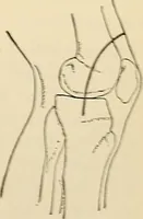 An illustration from Surgical technic; a text-book on operative surgery / by Fr. von Esmarch ... and E. Kowalzig ... translated by Professor Ludwig H. Grau ... and Willam N. Sullivan ... edited by Nicholas Senn ... With fourteen hundred and ninety-seven illustrations and fifteen colored plates. (1901)