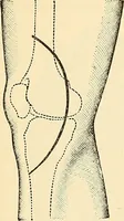 An illustration from Surgical technic; a text-book on operative surgery / by Fr. von Esmarch ... and E. Kowalzig ... translated by Professor Ludwig H. Grau ... and Willam N. Sullivan ... edited by Nicholas Senn ... With fourteen hundred and ninety-seven illustrations and fifteen colored plates. (1901)