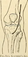 An illustration from Surgical technic; a text-book on operative surgery / by Fr. von Esmarch ... and E. Kowalzig ... translated by Professor Ludwig H. Grau ... and Willam N. Sullivan ... edited by Nicholas Senn ... With fourteen hundred and ninety-seven illustrations and fifteen colored plates. (1901)