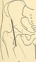 An illustration from Surgical technic; a text-book on operative surgery / by Fr. von Esmarch ... and E. Kowalzig ... translated by Professor Ludwig H. Grau ... and Willam N. Sullivan ... edited by Nicholas Senn ... With fourteen hundred and ninety-seven illustrations and fifteen colored plates. (1901)