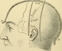 An illustration from Surgical technic; a text-book on operative surgery / by Fr. von Esmarch ... and E. Kowalzig ... translated by Professor Ludwig H. Grau ... and Willam N. Sullivan ... edited by Nicholas Senn ... With fourteen hundred and ninety-seven illustrations and fifteen colored plates. (1901)
