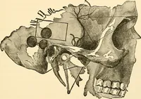 An illustration from Surgical technic; a text-book on operative surgery / by Fr. von Esmarch ... and E. Kowalzig ... translated by Professor Ludwig H. Grau ... and Willam N. Sullivan ... edited by Nicholas Senn ... With fourteen hundred and ninety-seven illustrations and fifteen colored plates. (1901)