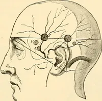An illustration from Surgical technic; a text-book on operative surgery / by Fr. von Esmarch ... and E. Kowalzig ... translated by Professor Ludwig H. Grau ... and Willam N. Sullivan ... edited by Nicholas Senn ... With fourteen hundred and ninety-seven illustrations and fifteen colored plates. (1901)