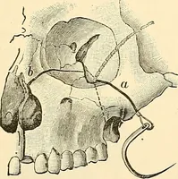 An illustration from Surgical technic; a text-book on operative surgery / by Fr. von Esmarch ... and E. Kowalzig ... translated by Professor Ludwig H. Grau ... and Willam N. Sullivan ... edited by Nicholas Senn ... With fourteen hundred and ninety-seven illustrations and fifteen colored plates. (1901)