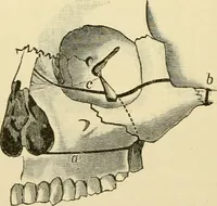 An illustration from Surgical technic; a text-book on operative surgery / by Fr. von Esmarch ... and E. Kowalzig ... translated by Professor Ludwig H. Grau ... and Willam N. Sullivan ... edited by Nicholas Senn ... With fourteen hundred and ninety-seven illustrations and fifteen colored plates. (1901)