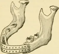 An illustration from Surgical technic; a text-book on operative surgery / by Fr. von Esmarch ... and E. Kowalzig ... translated by Professor Ludwig H. Grau ... and Willam N. Sullivan ... edited by Nicholas Senn ... With fourteen hundred and ninety-seven illustrations and fifteen colored plates. (1901)
