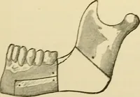 An illustration from Surgical technic; a text-book on operative surgery / by Fr. von Esmarch ... and E. Kowalzig ... translated by Professor Ludwig H. Grau ... and Willam N. Sullivan ... edited by Nicholas Senn ... With fourteen hundred and ninety-seven illustrations and fifteen colored plates. (1901)