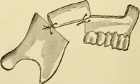 An illustration from Surgical technic; a text-book on operative surgery / by Fr. von Esmarch ... and E. Kowalzig ... translated by Professor Ludwig H. Grau ... and Willam N. Sullivan ... edited by Nicholas Senn ... With fourteen hundred and ninety-seven illustrations and fifteen colored plates. (1901)